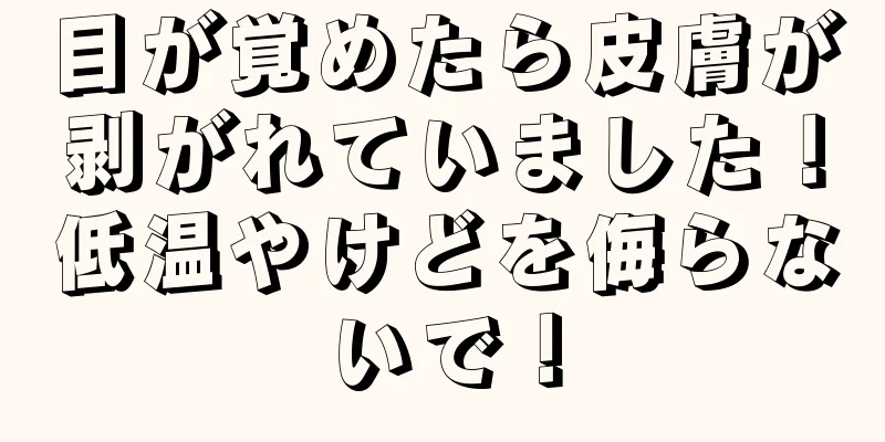 目が覚めたら皮膚が剥がれていました！低温やけどを侮らないで！