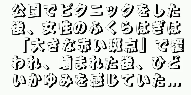 公園でピクニックをした後、女性のふくらはぎは「大きな赤い斑点」で覆われ、噛まれた後、ひどいかゆみを感じていた...
